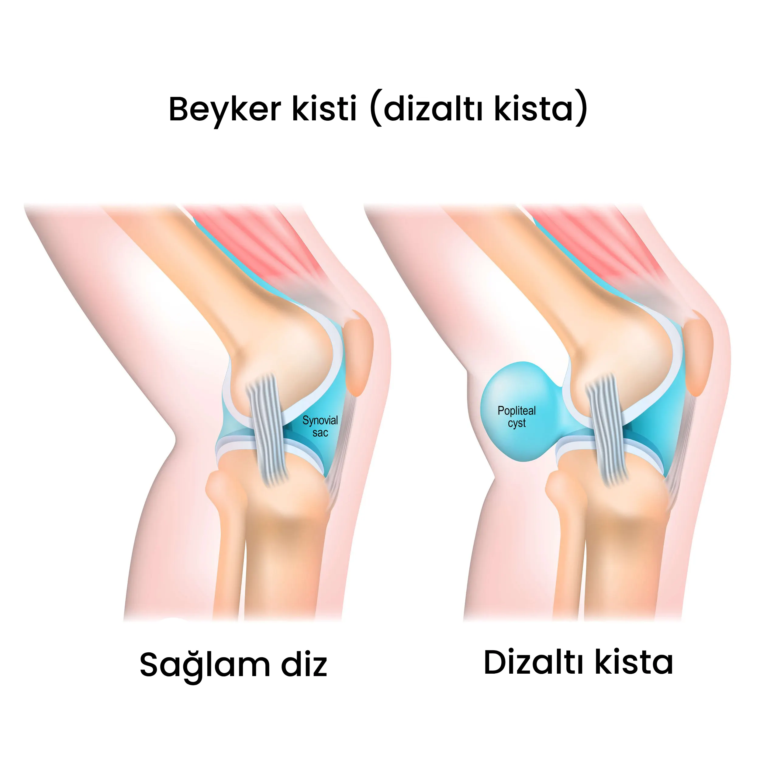 beyker kisti