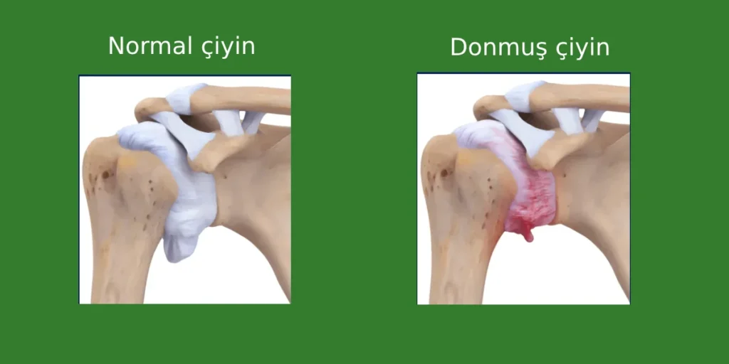 donmuş çiyin sindromu