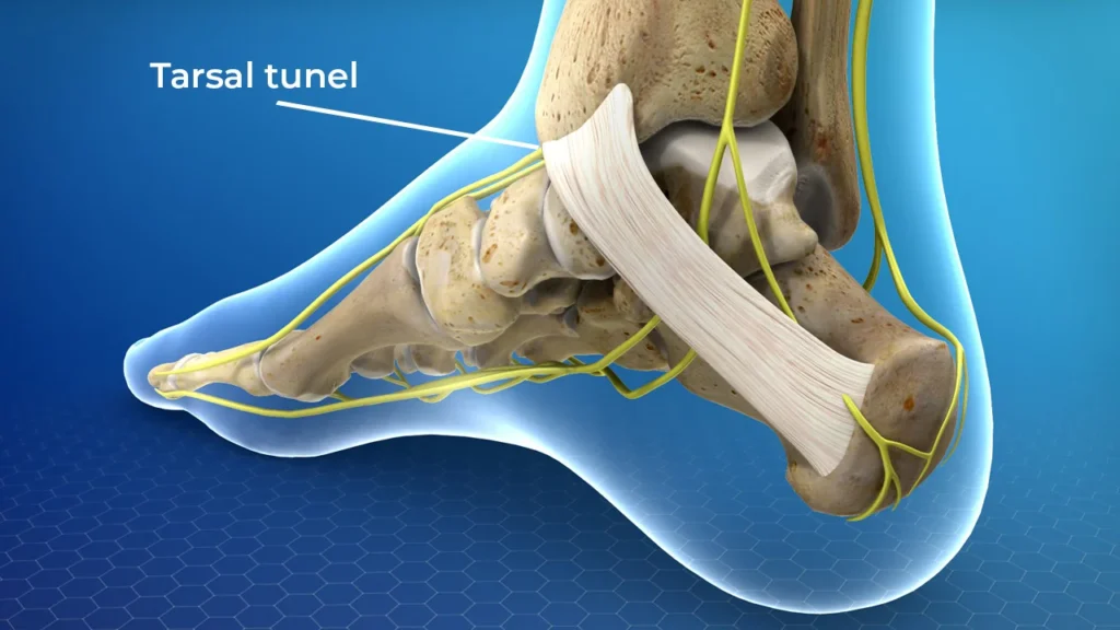 tarsal tunel