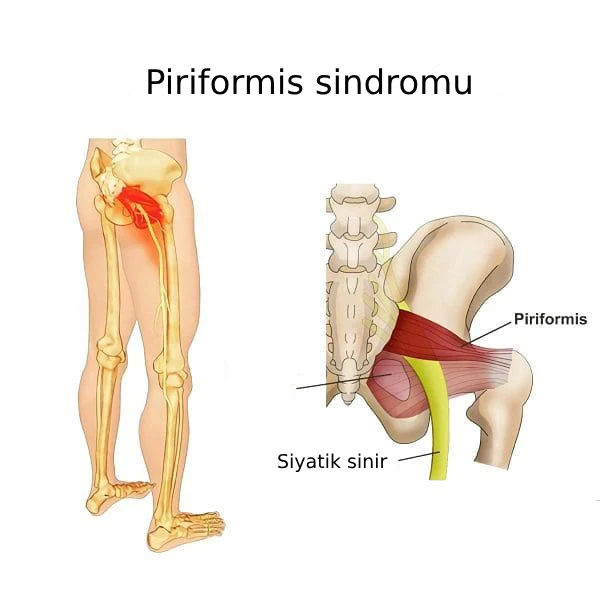 piriformis sindromu müalicəsi
