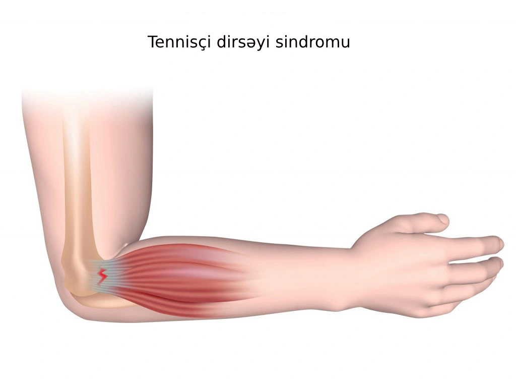 tennisçi dirsəyi sindromu