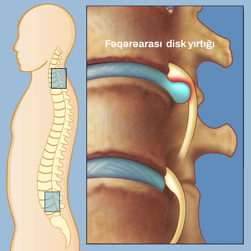 disk yırtığı