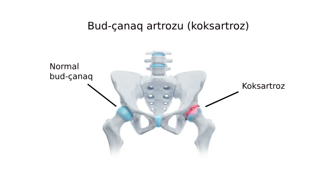 bud-çanaq artrozu