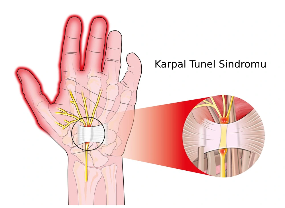 karpal tunel sindromu niyə yaranır