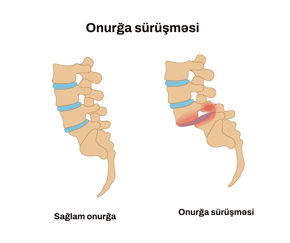 onurğa sürüşməsi