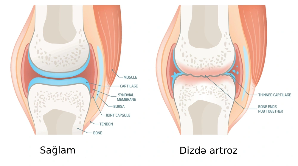 Artroz nədir? Əlamətləri və müalicəsi - Uzman Fizioterapevt Əziz Dəvrişov